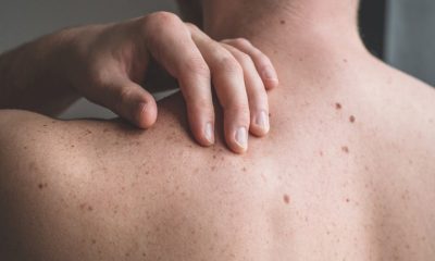 Skin cancer vaccine