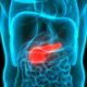The relationship between high blood insulin levels and pancreatic cancer