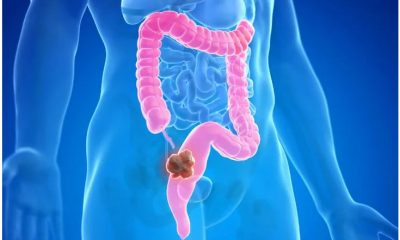 colon cancer