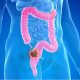 colon cancer