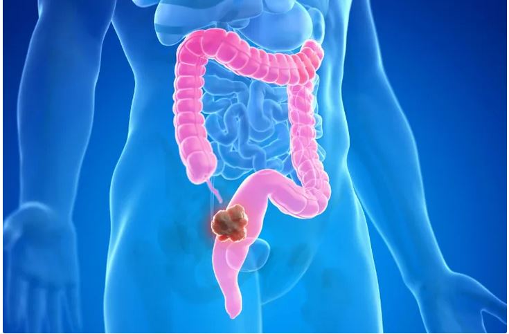 colon cancer